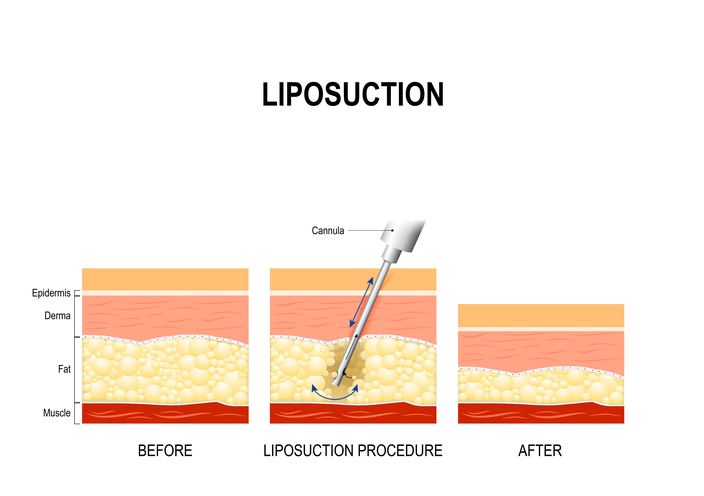 liposuction in White Plains