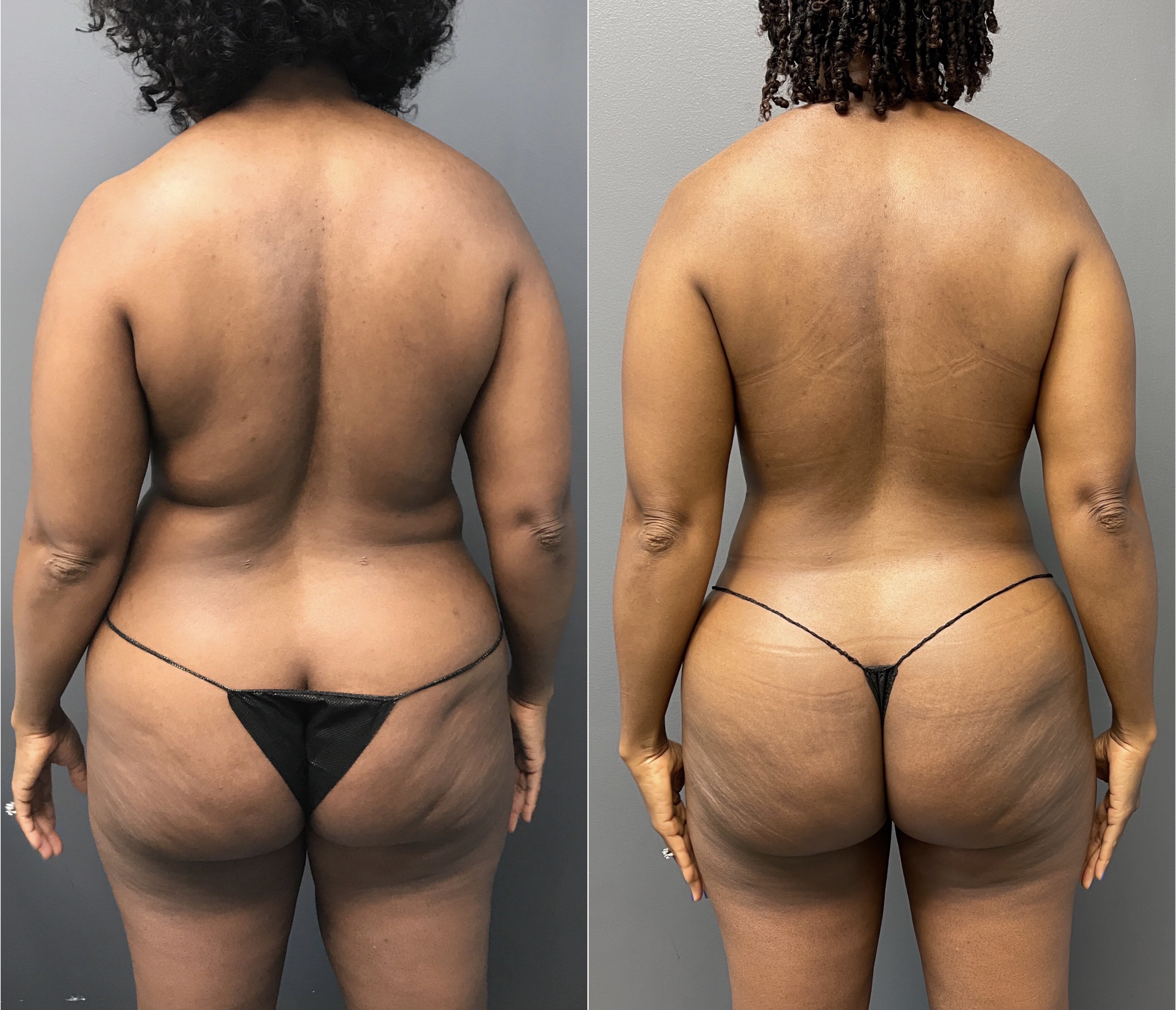 Body Fat Grafting Before and After | Dr. Maura Reinblatt