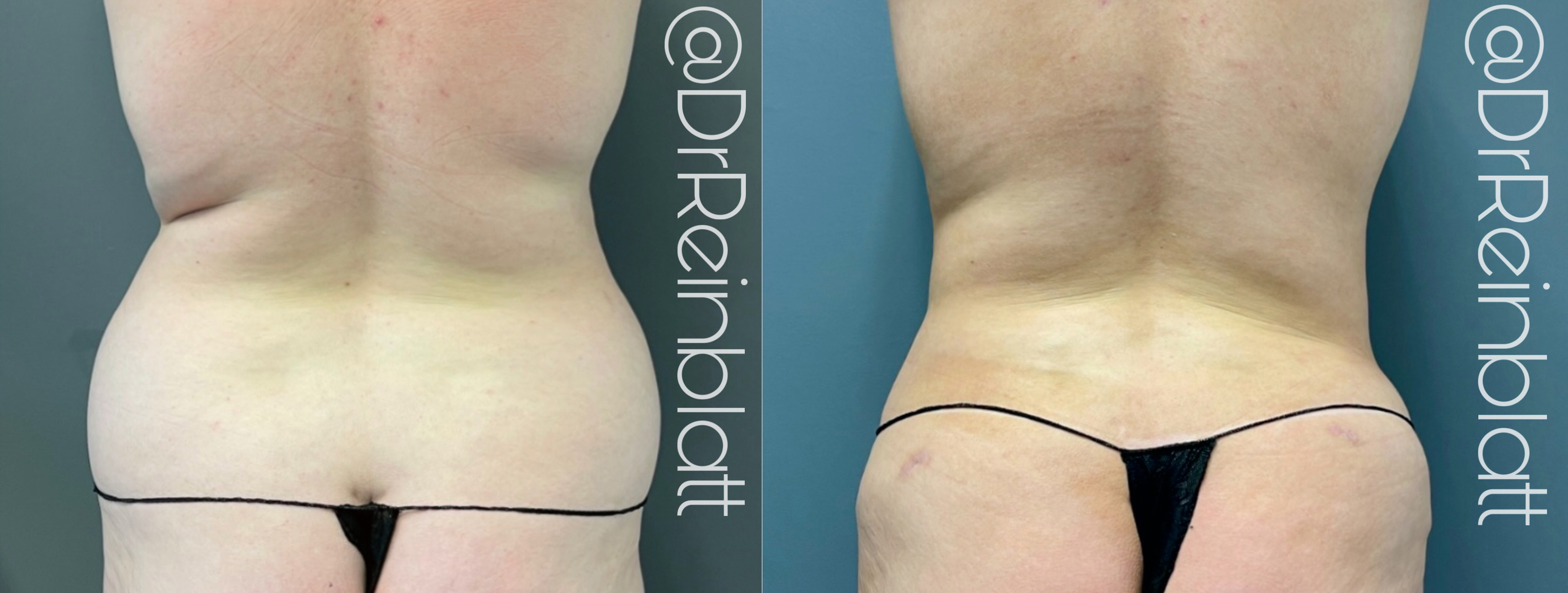 Liposuction Before and After | Dr. Maura Reinblatt