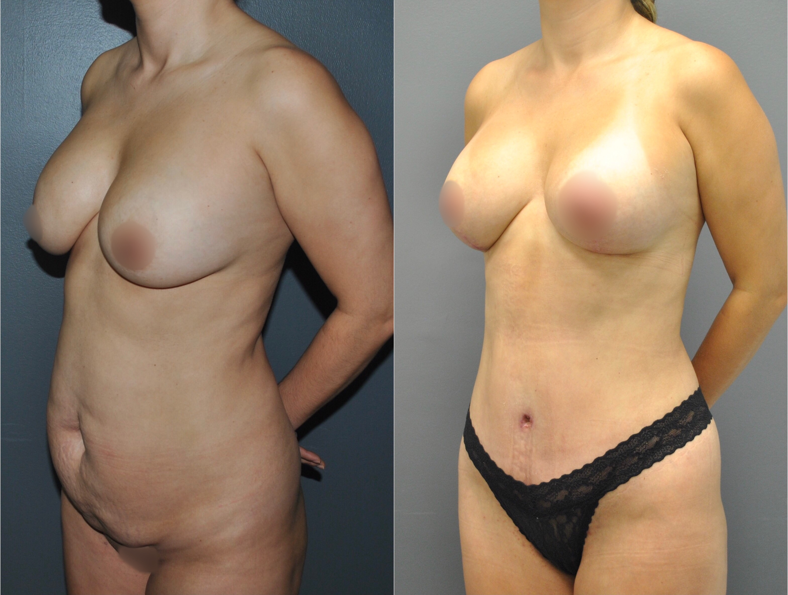 Mommy Makeover Before and After | Dr. Maura Reinblatt