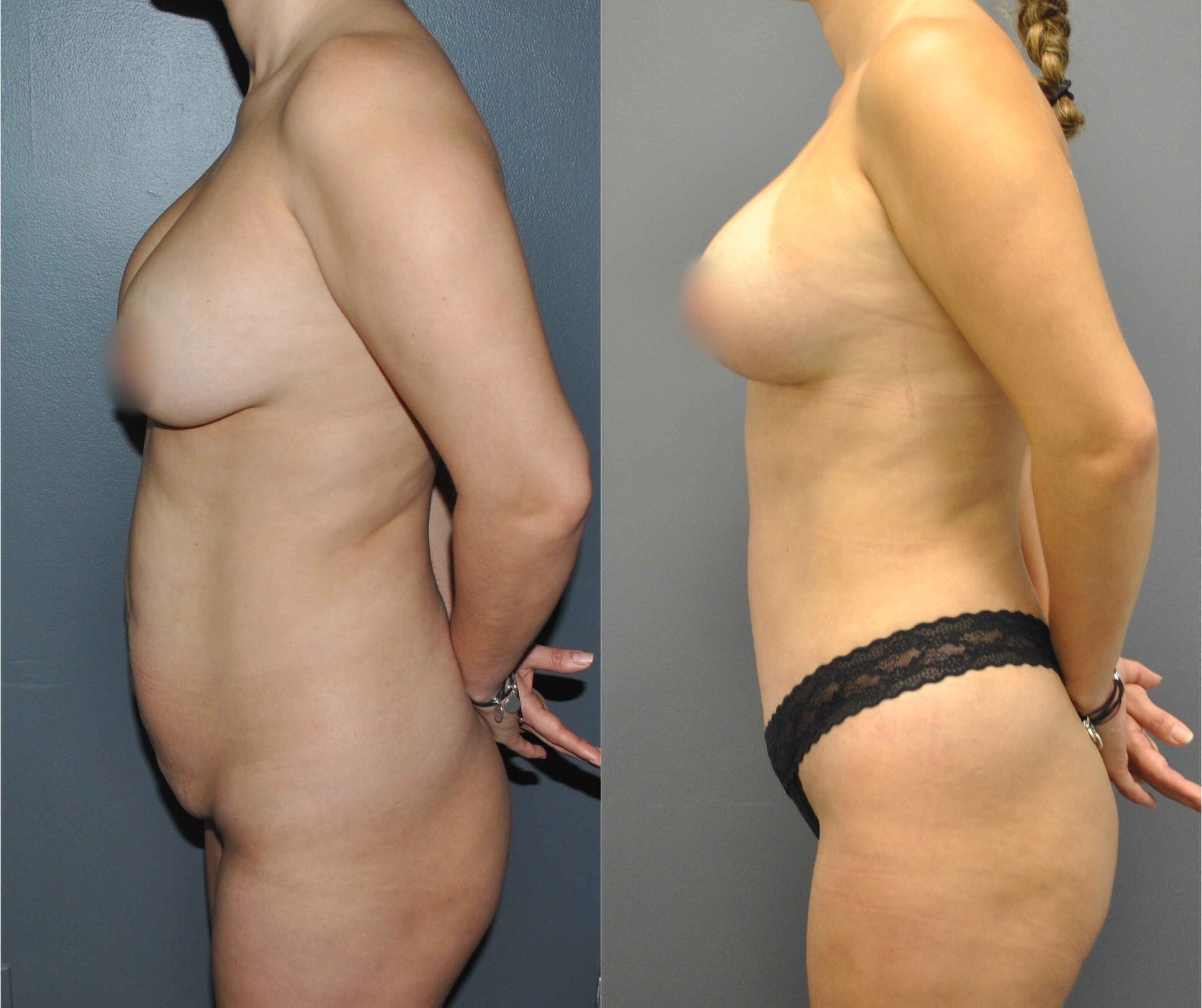 Mommy Makeover Before and After | Dr. Maura Reinblatt