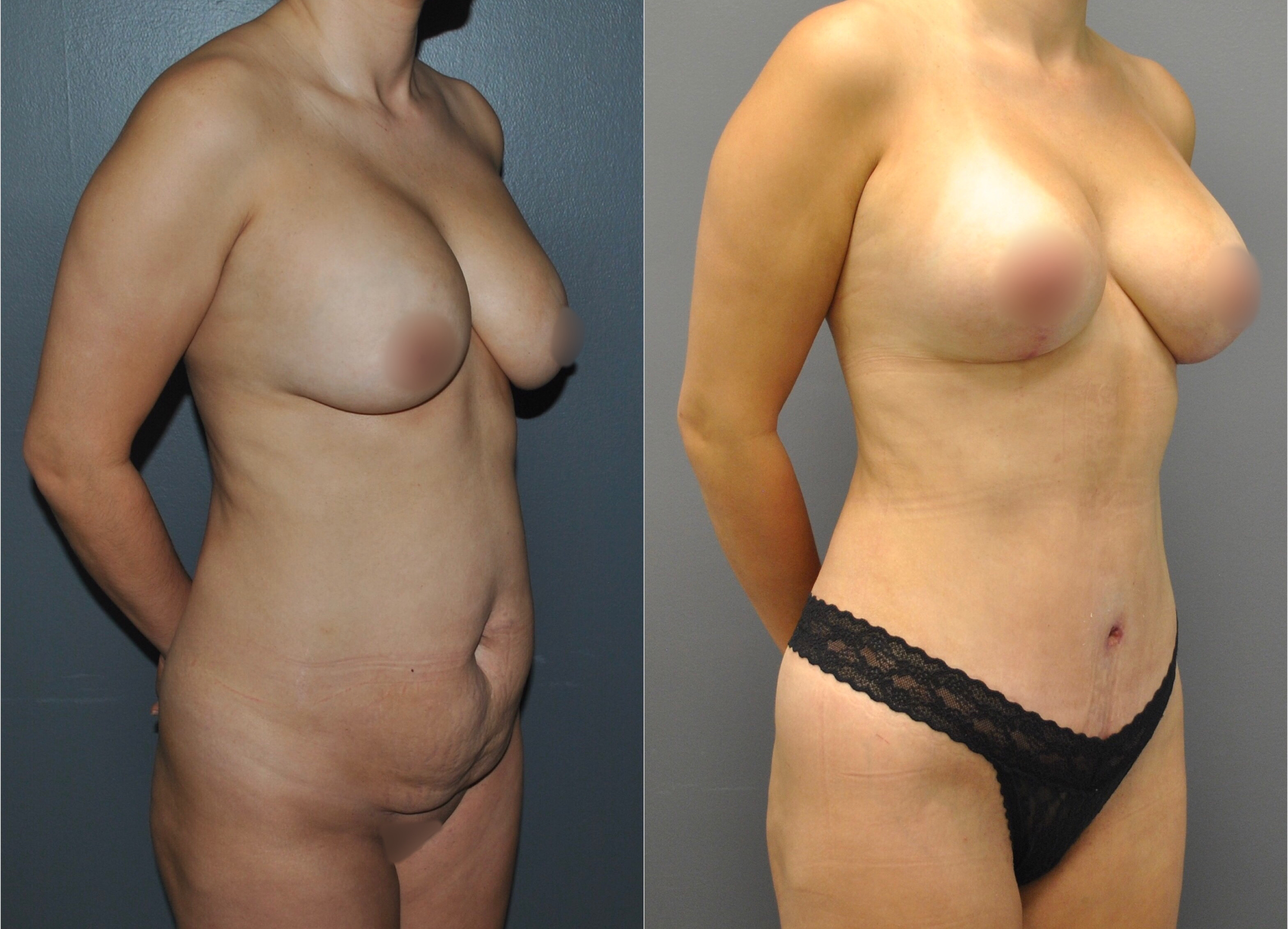 Mommy Makeover Before and After | Dr. Maura Reinblatt