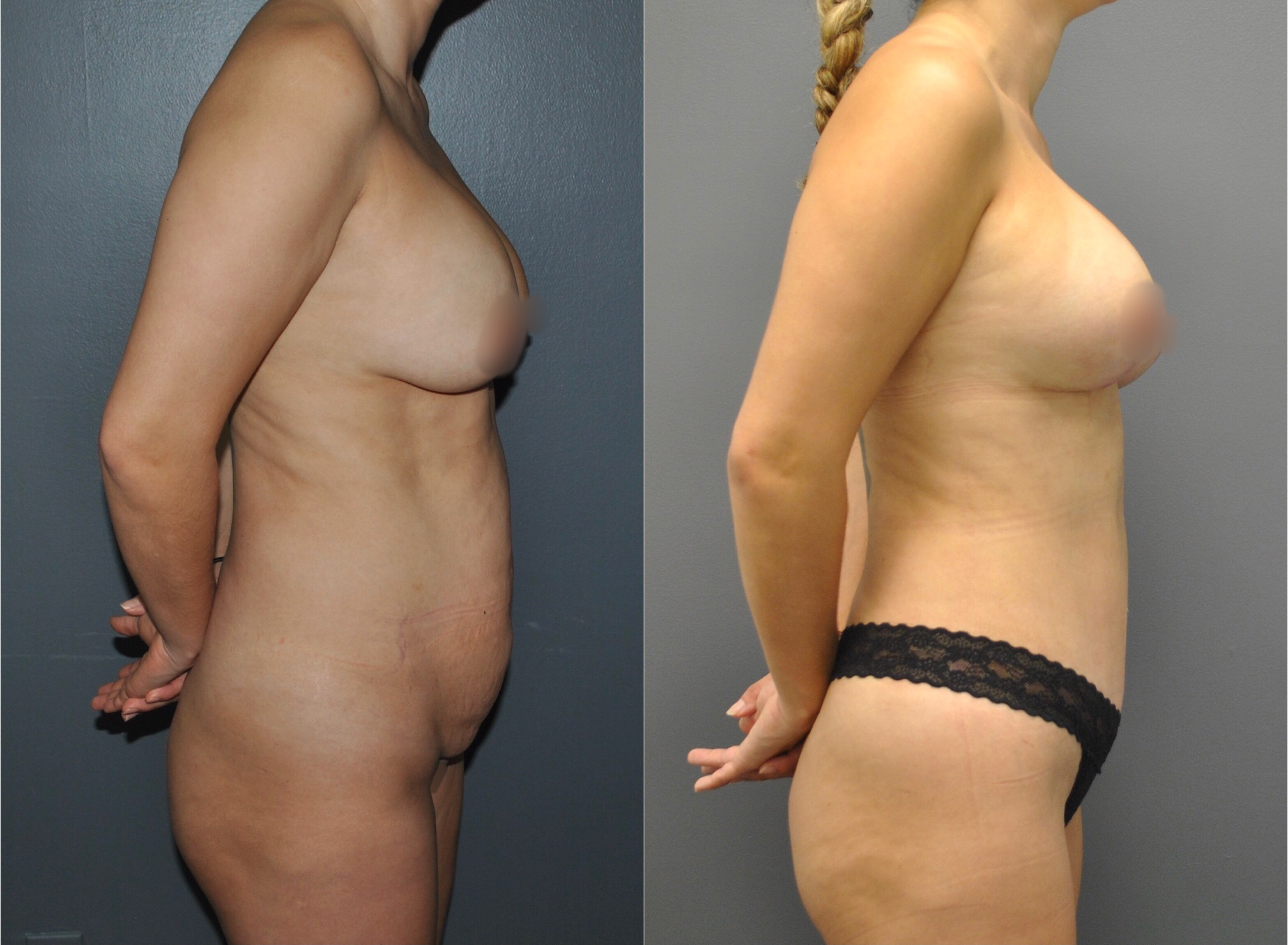 Mommy Makeover Before and After | Dr. Maura Reinblatt