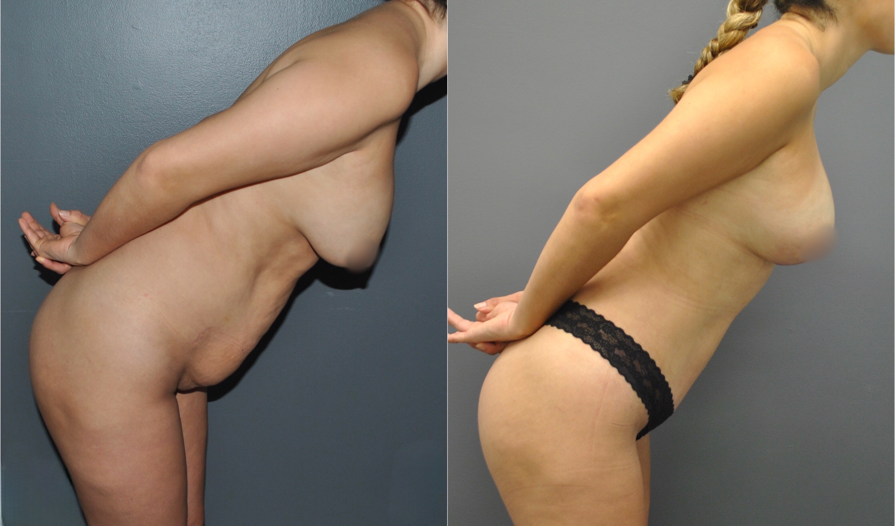 Mommy Makeover Before and After | Dr. Maura Reinblatt