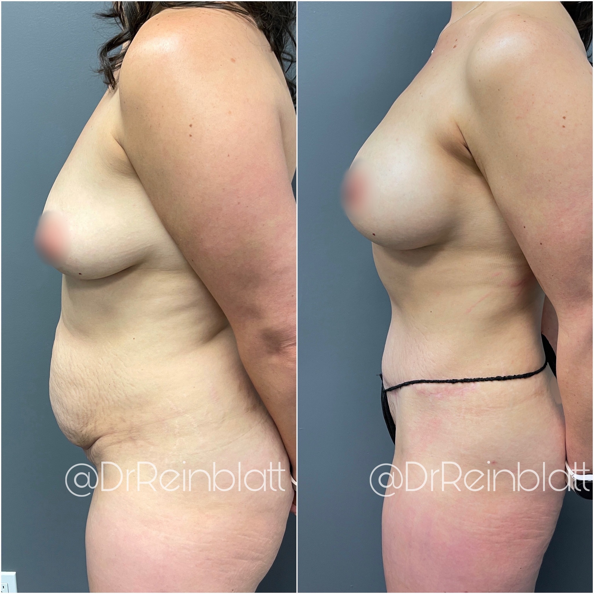 Tummy Tuck Before and After | Dr. Maura Reinblatt