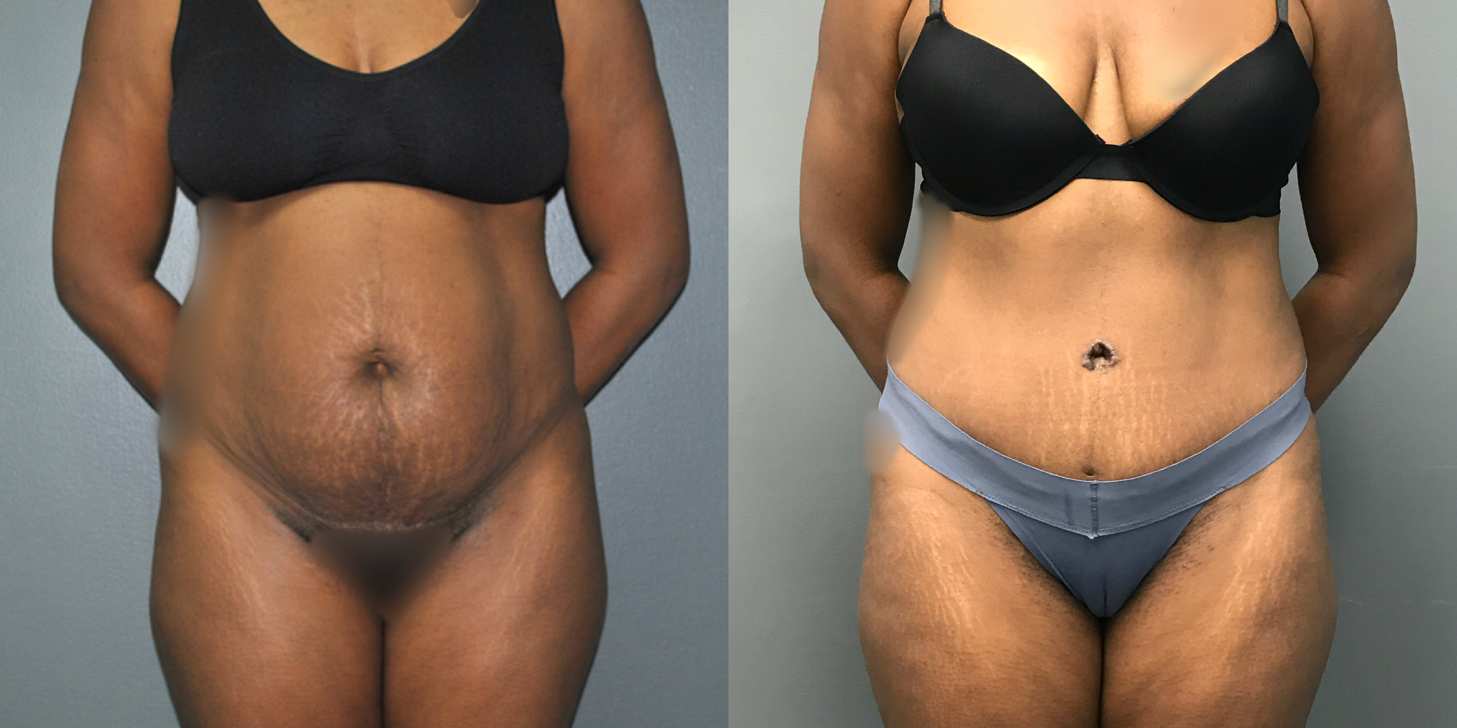 Tummy Tuck Before and After | Dr. Maura Reinblatt