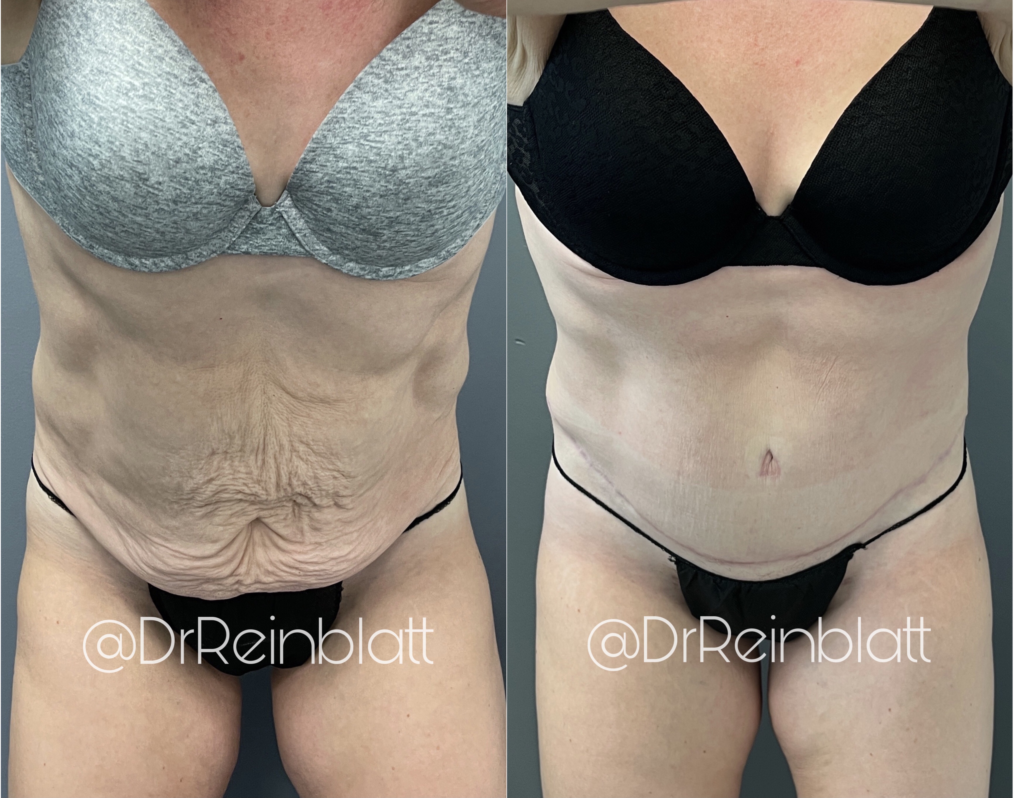 Tummy Tuck Before and After | Dr. Maura Reinblatt