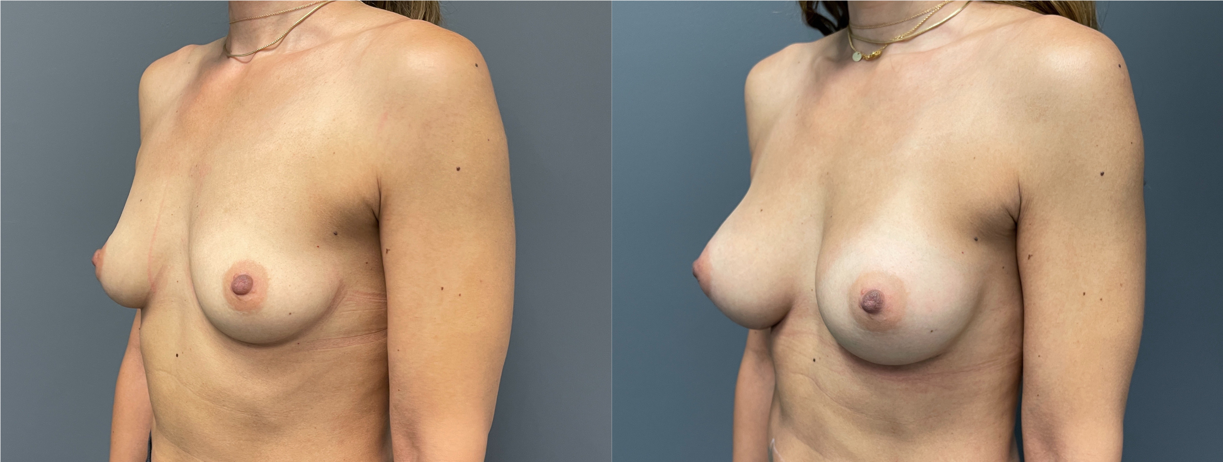 Breast Augmentation Before and After | Dr. Maura Reinblatt