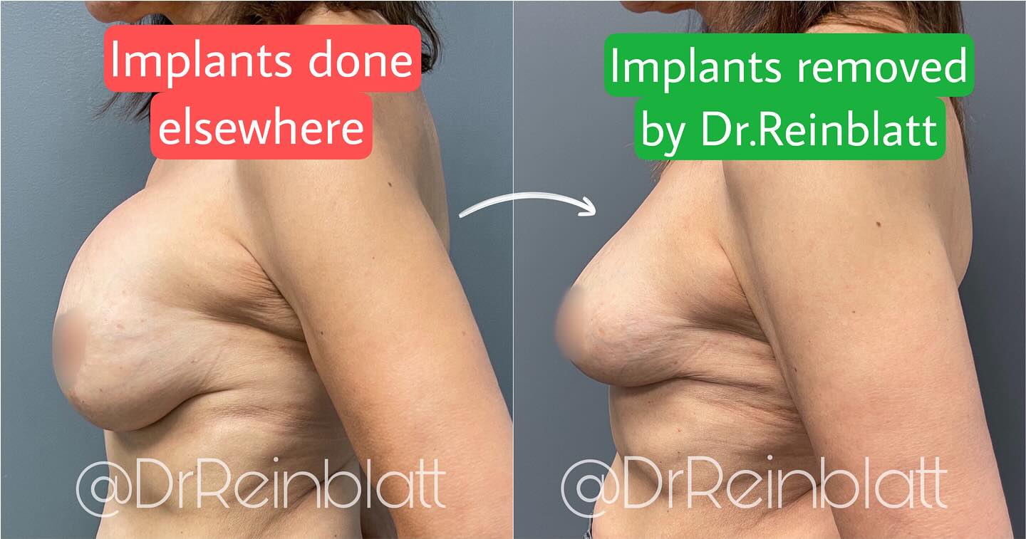 Breast Implant Removal Before and After | Dr. Maura Reinblatt