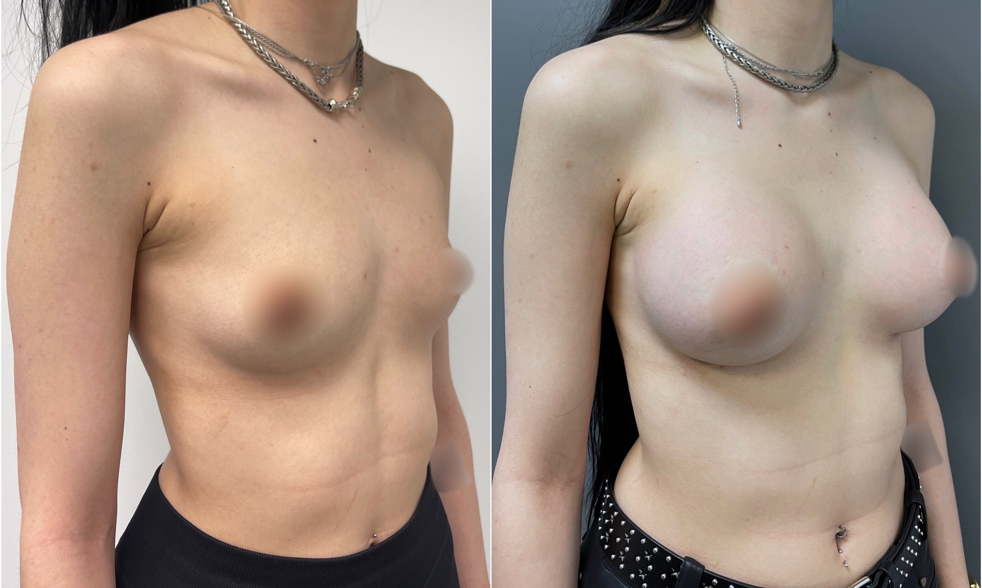Breast Lift Before and After | Dr. Maura Reinblatt