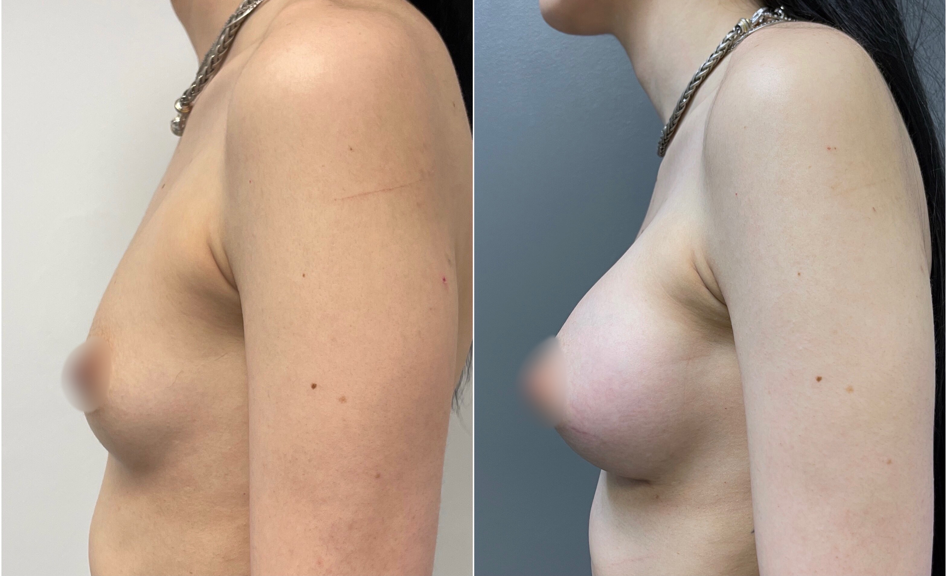 Breast Lift Before and After | Dr. Maura Reinblatt
