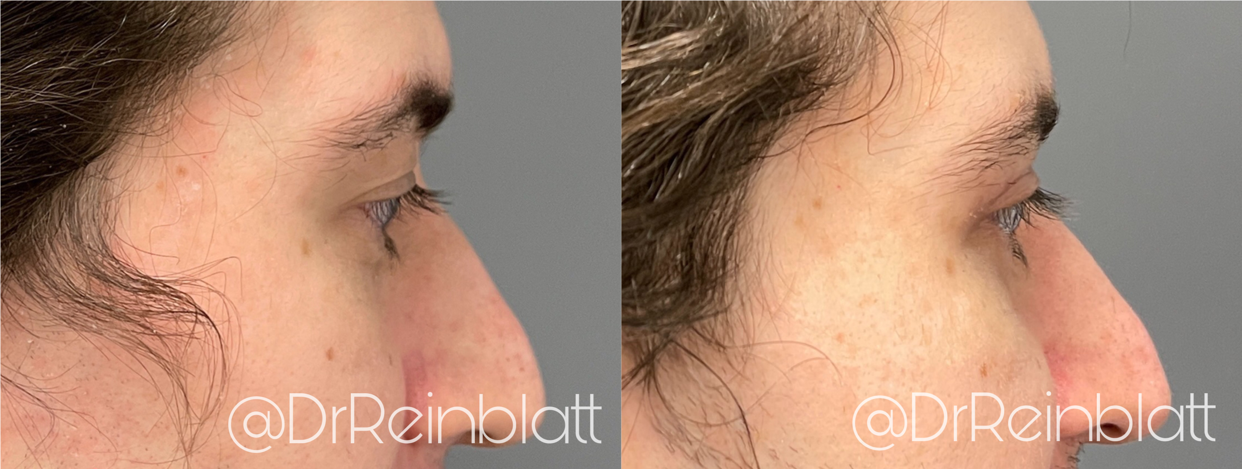 Blepharoplasty Before and After | Dr. Maura Reinblatt