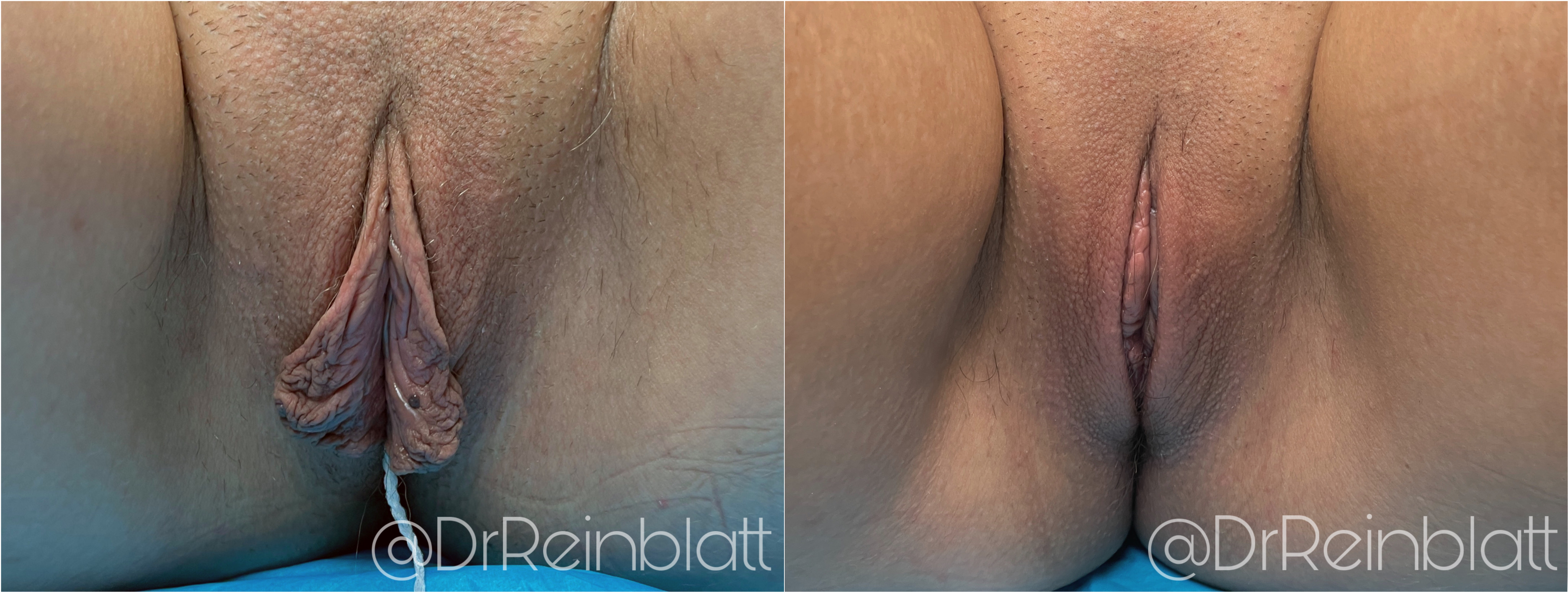 Labiaplasty Before and After | Dr. Maura Reinblatt