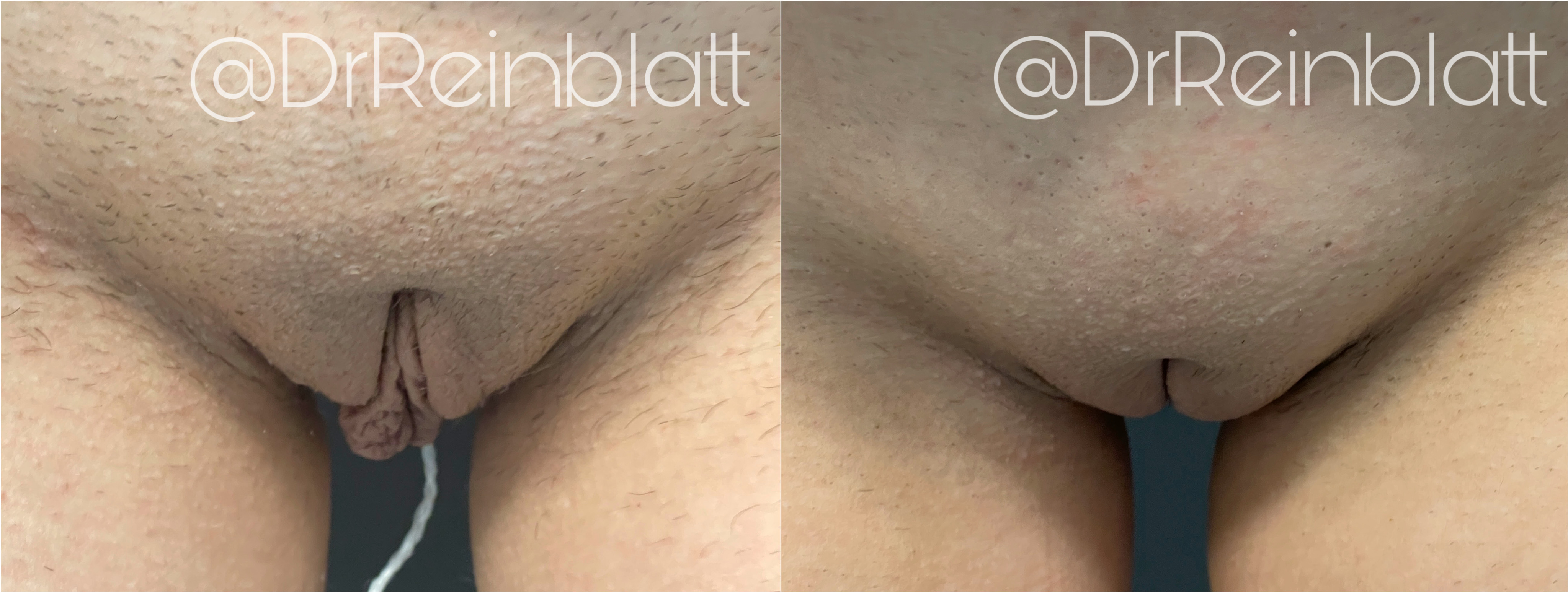 Labiaplasty Before and After | Dr. Maura Reinblatt