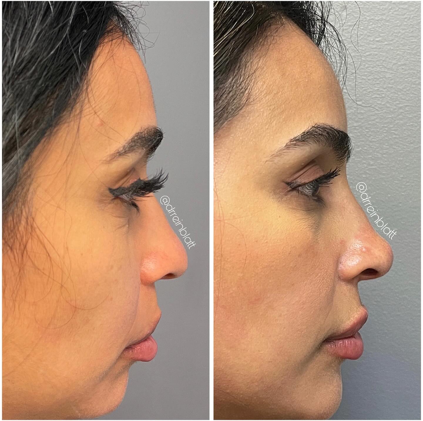 Liquid Rhinoplasty Before and After | Dr. Maura Reinblatt