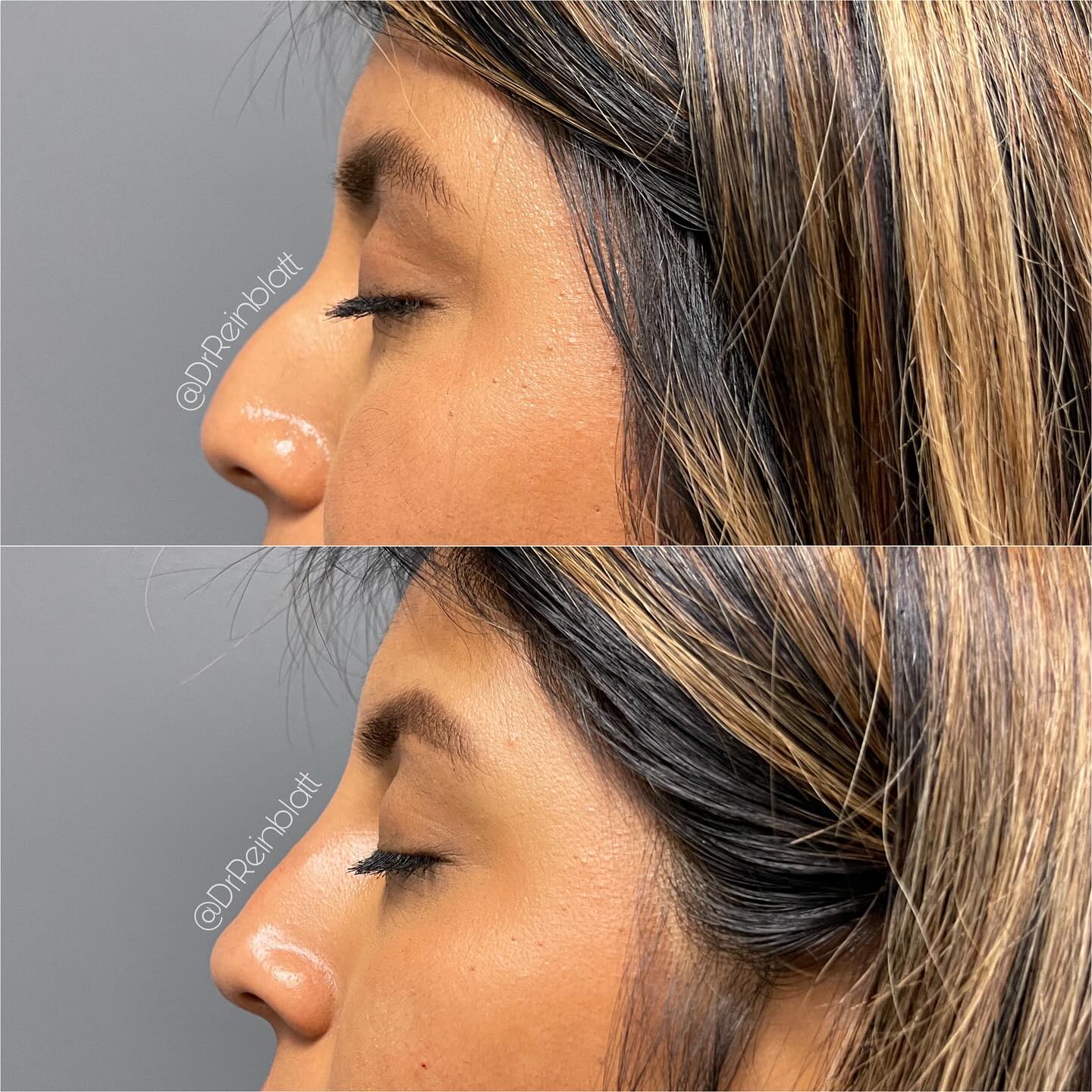 Liquid Rhinoplasty Before and After | Dr. Maura Reinblatt